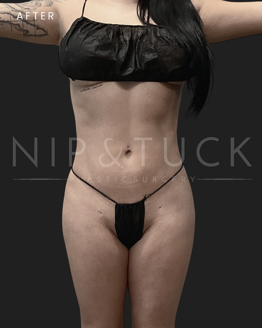 Lipo 360 Before & After