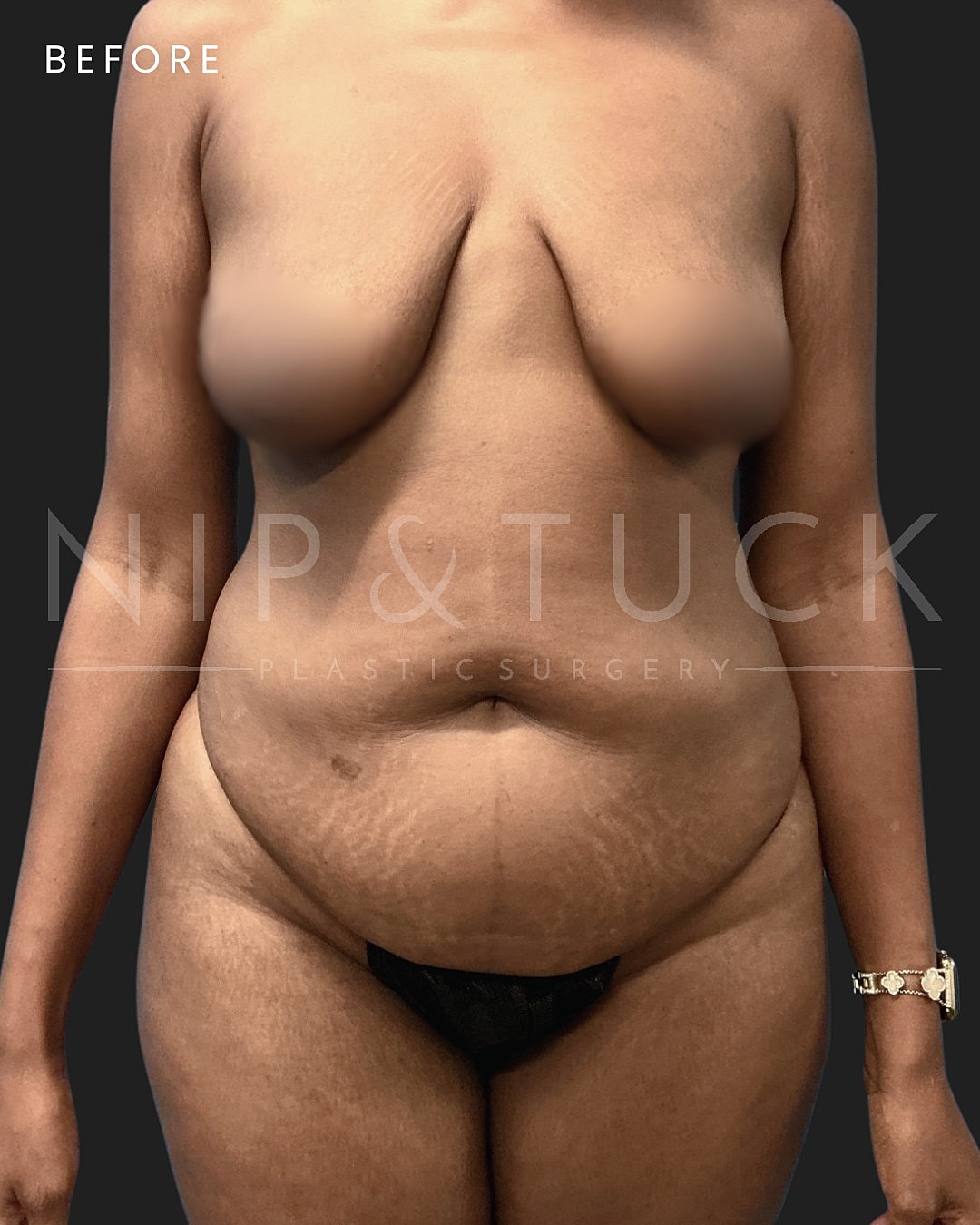 Lipo 360 Before & After