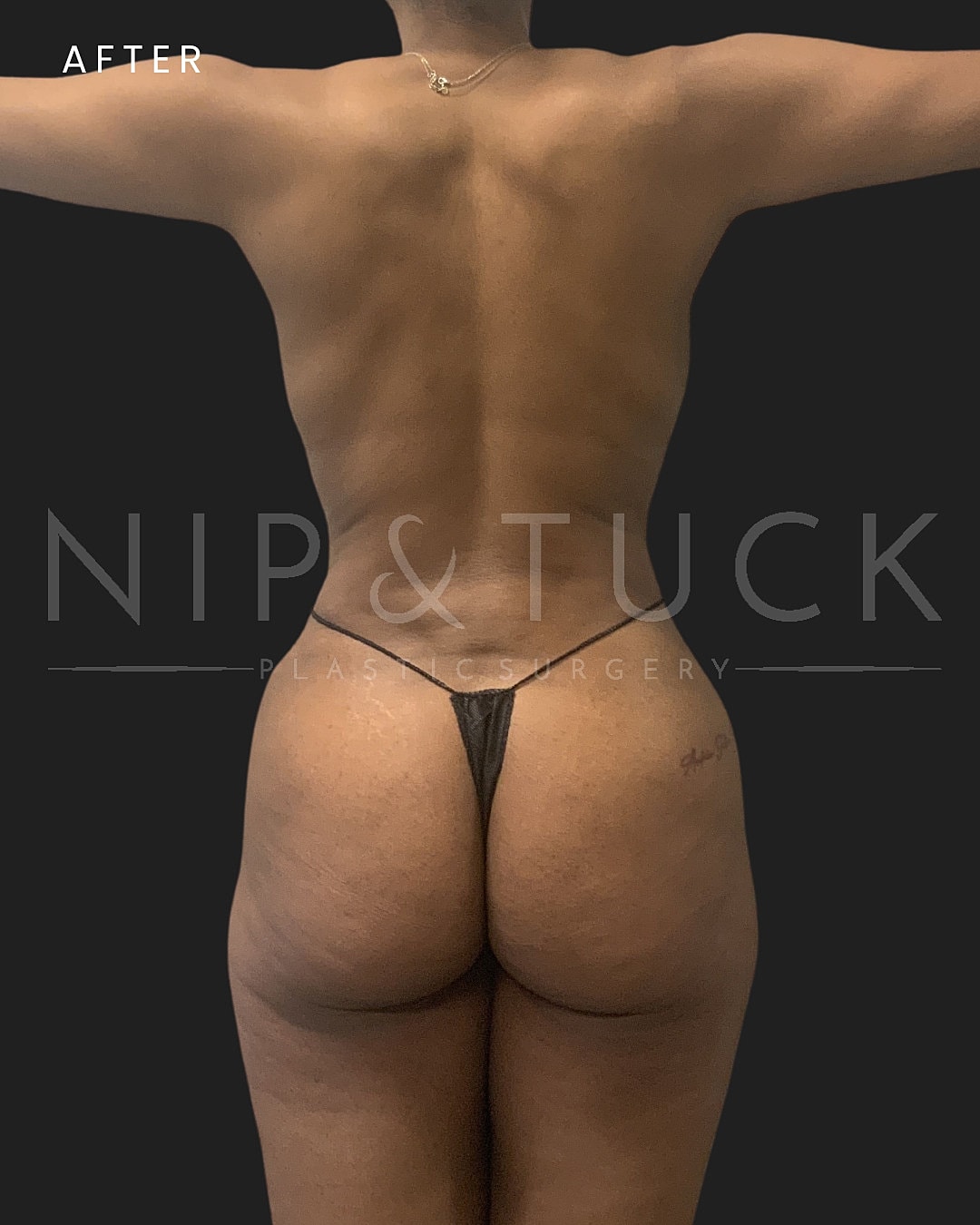 Lipo 360 Before & After