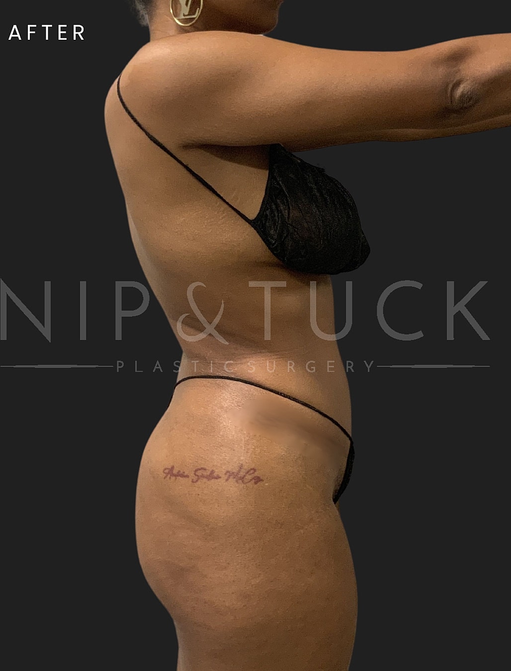 Lipo 360 Before & After