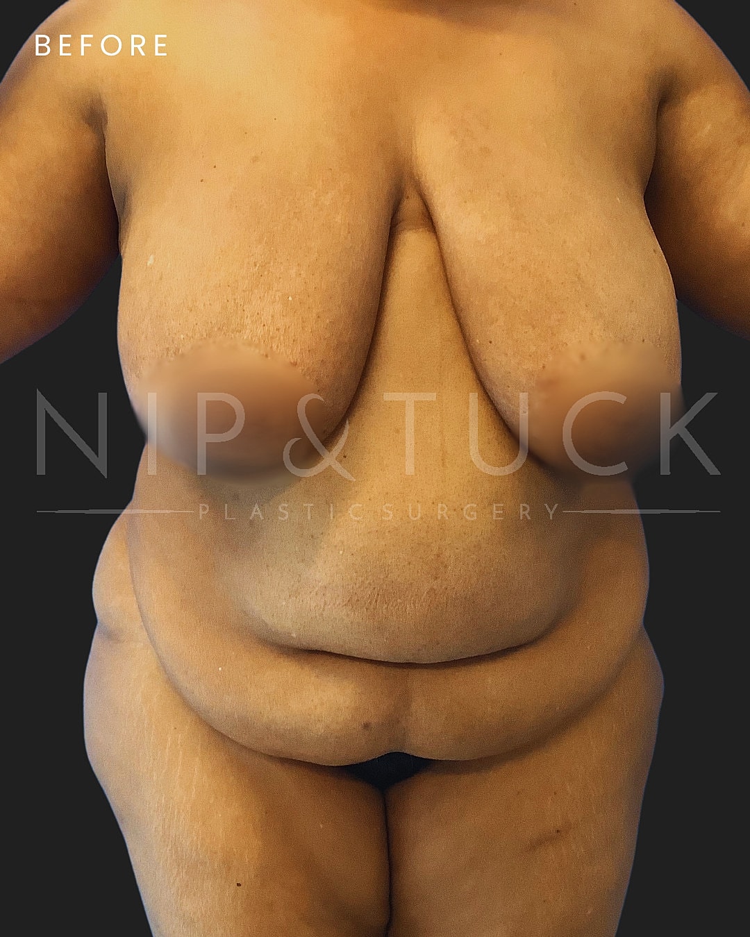 Lipo 360 Before & After