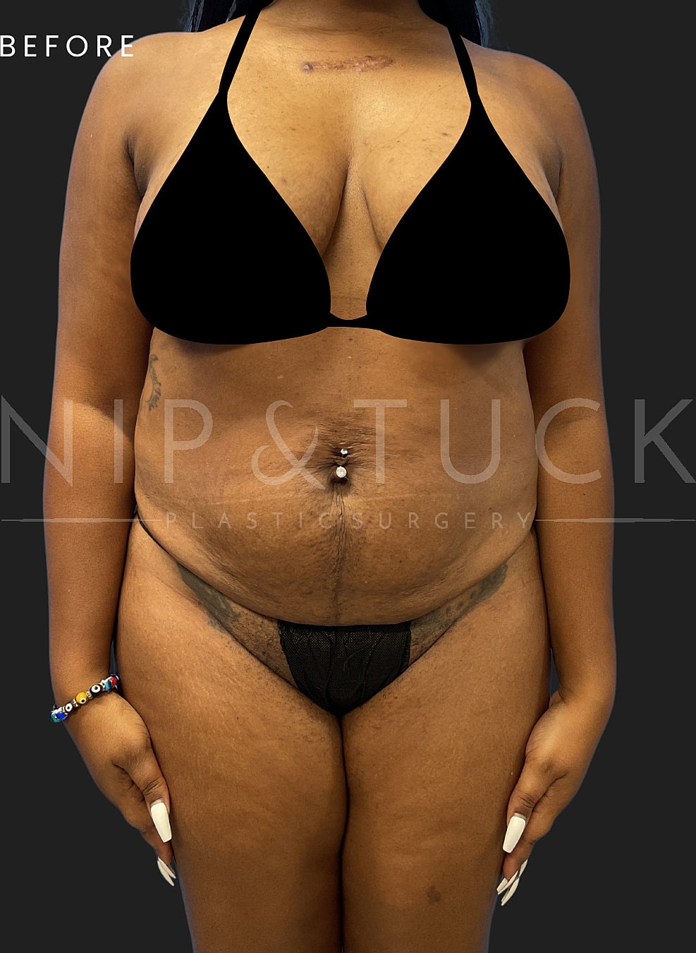 Lipo 360 Before & After
