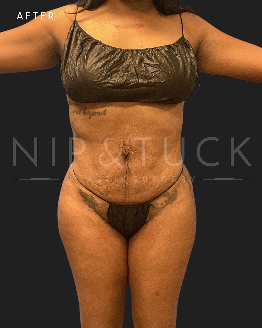 Lipo 360 Before & After