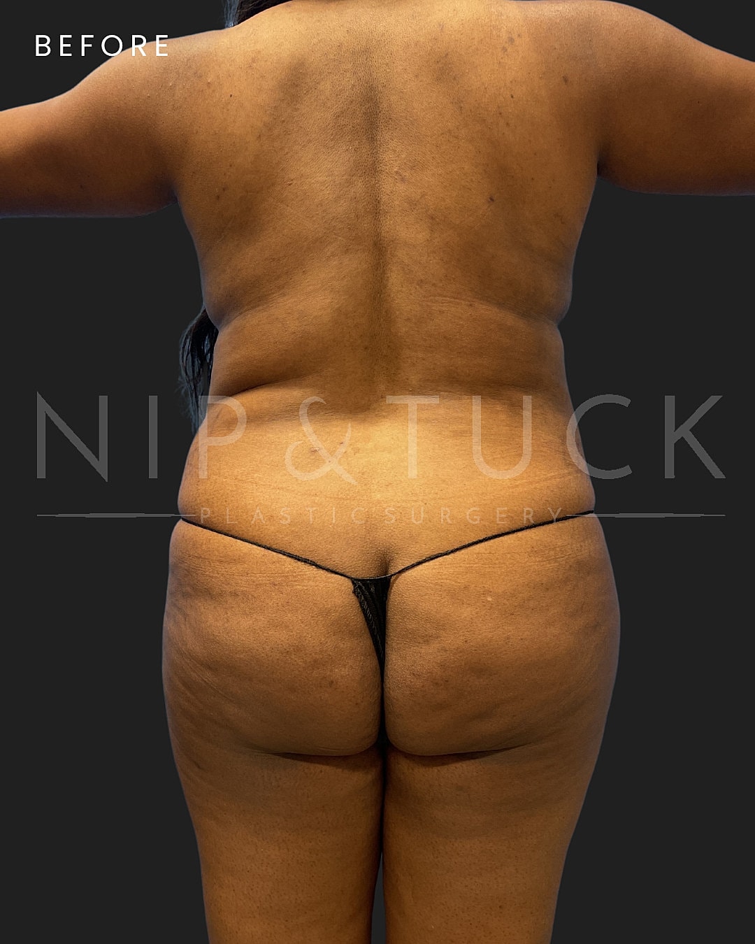Lipo 360 Before & After