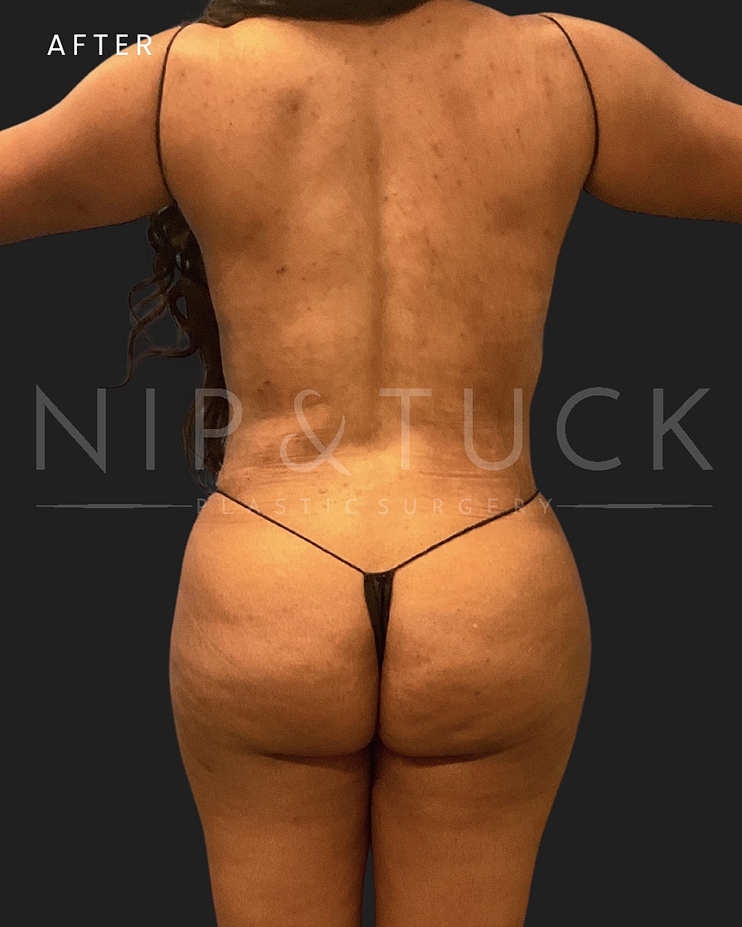Lipo 360 Before & After