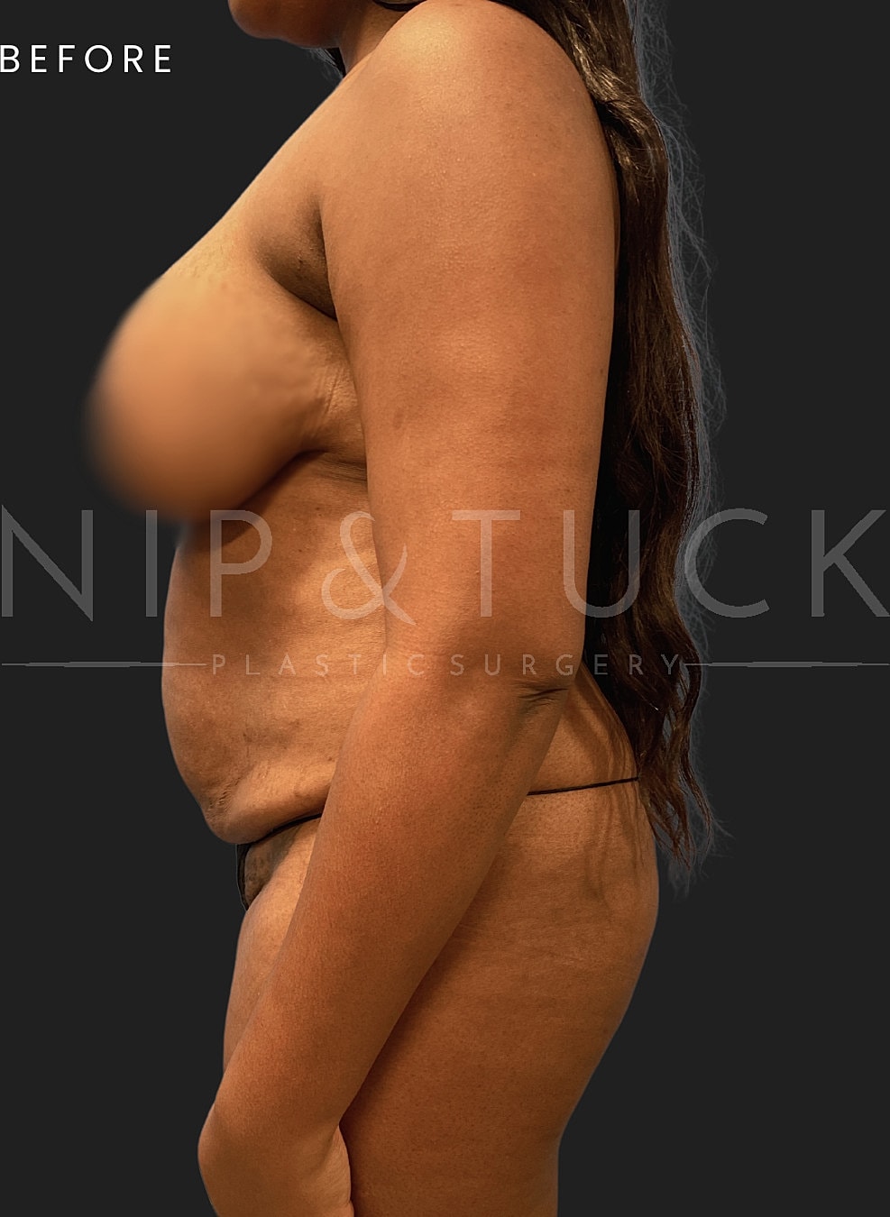 Lipo 360 Before & After