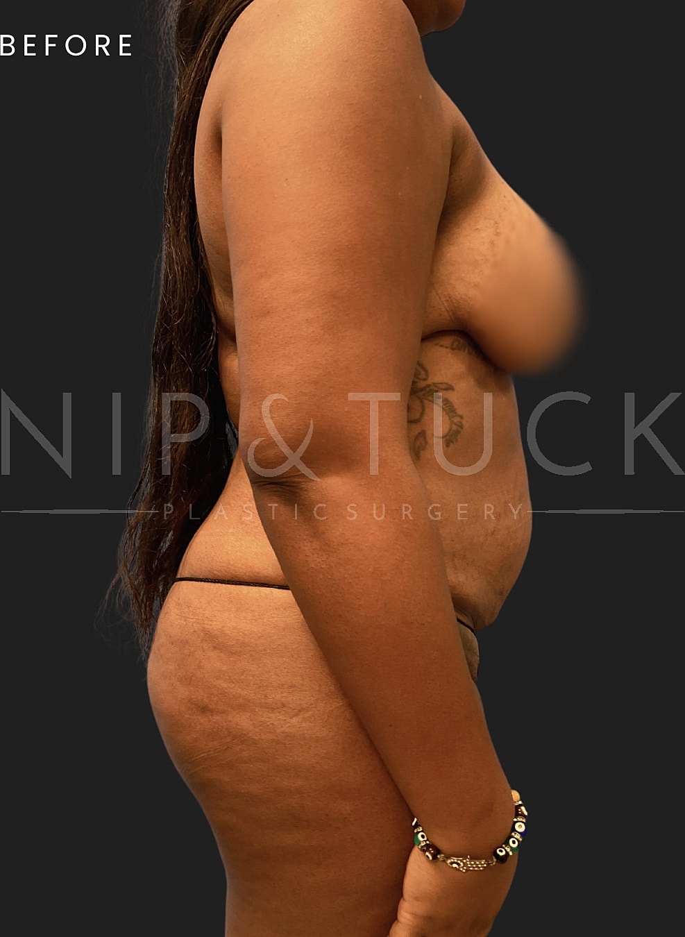 Lipo 360 Before & After