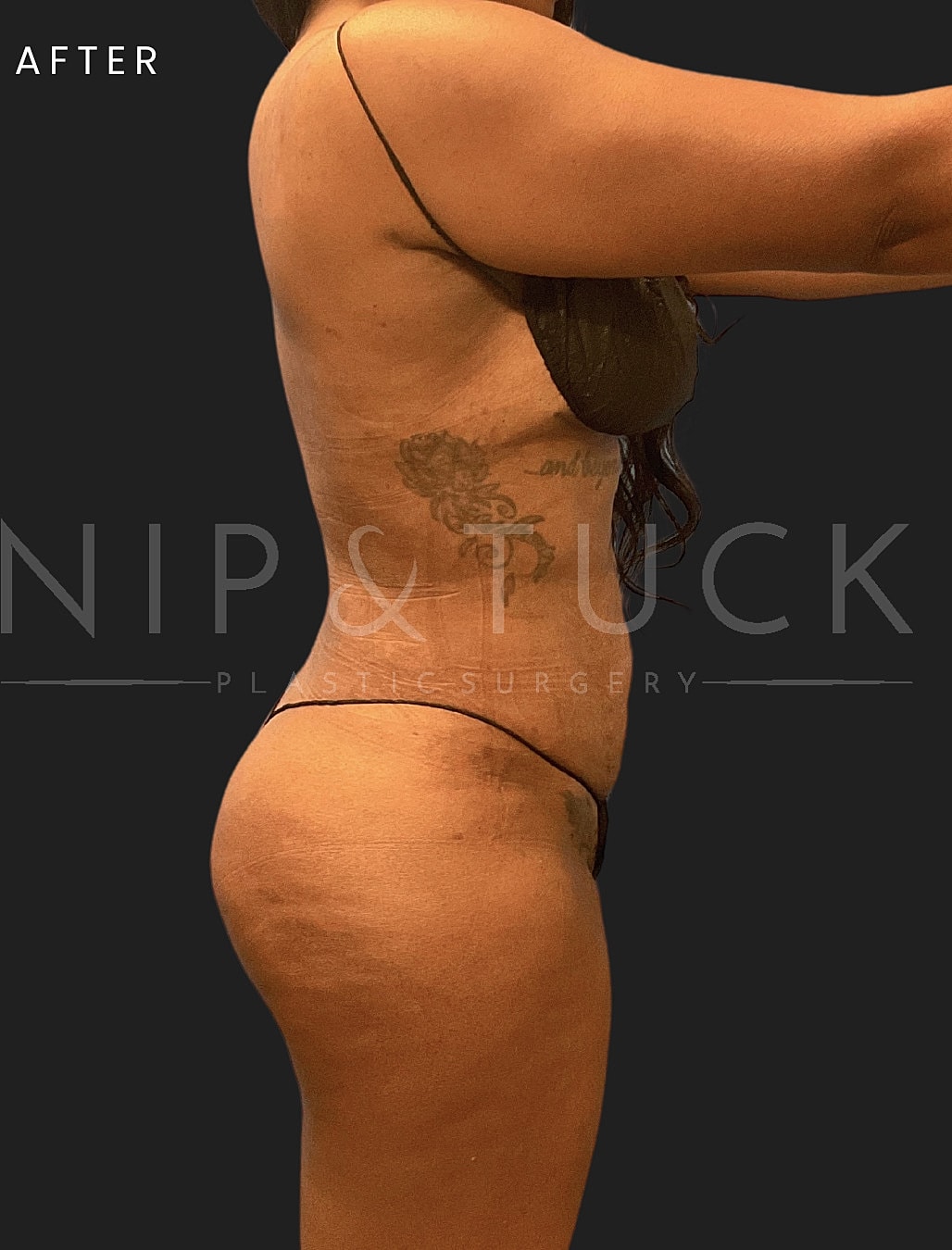 Lipo 360 Before & After