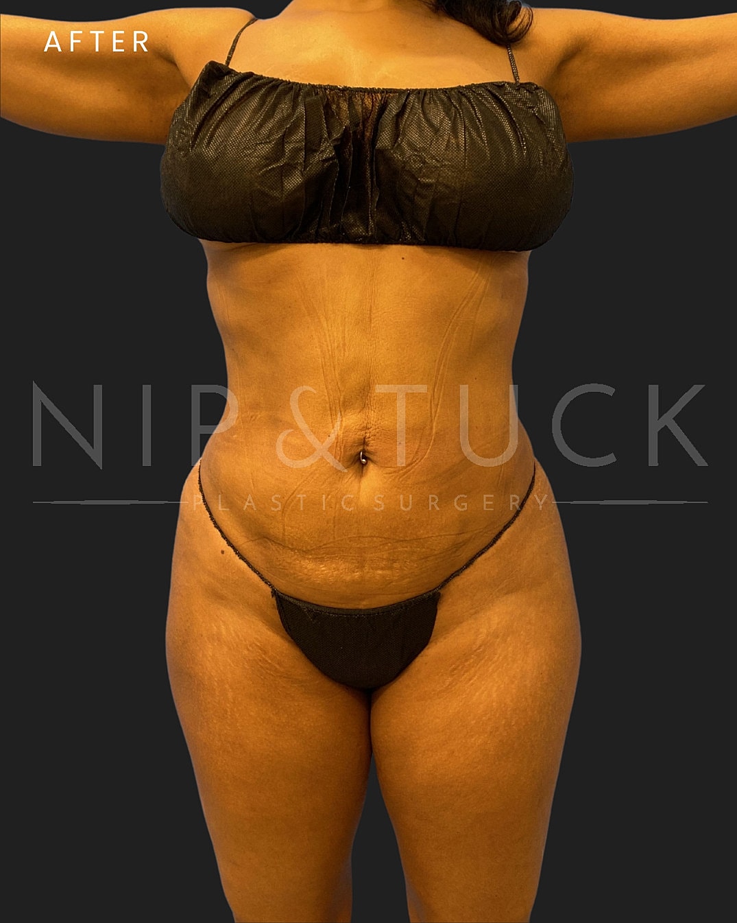 Lipo 360 Before & After