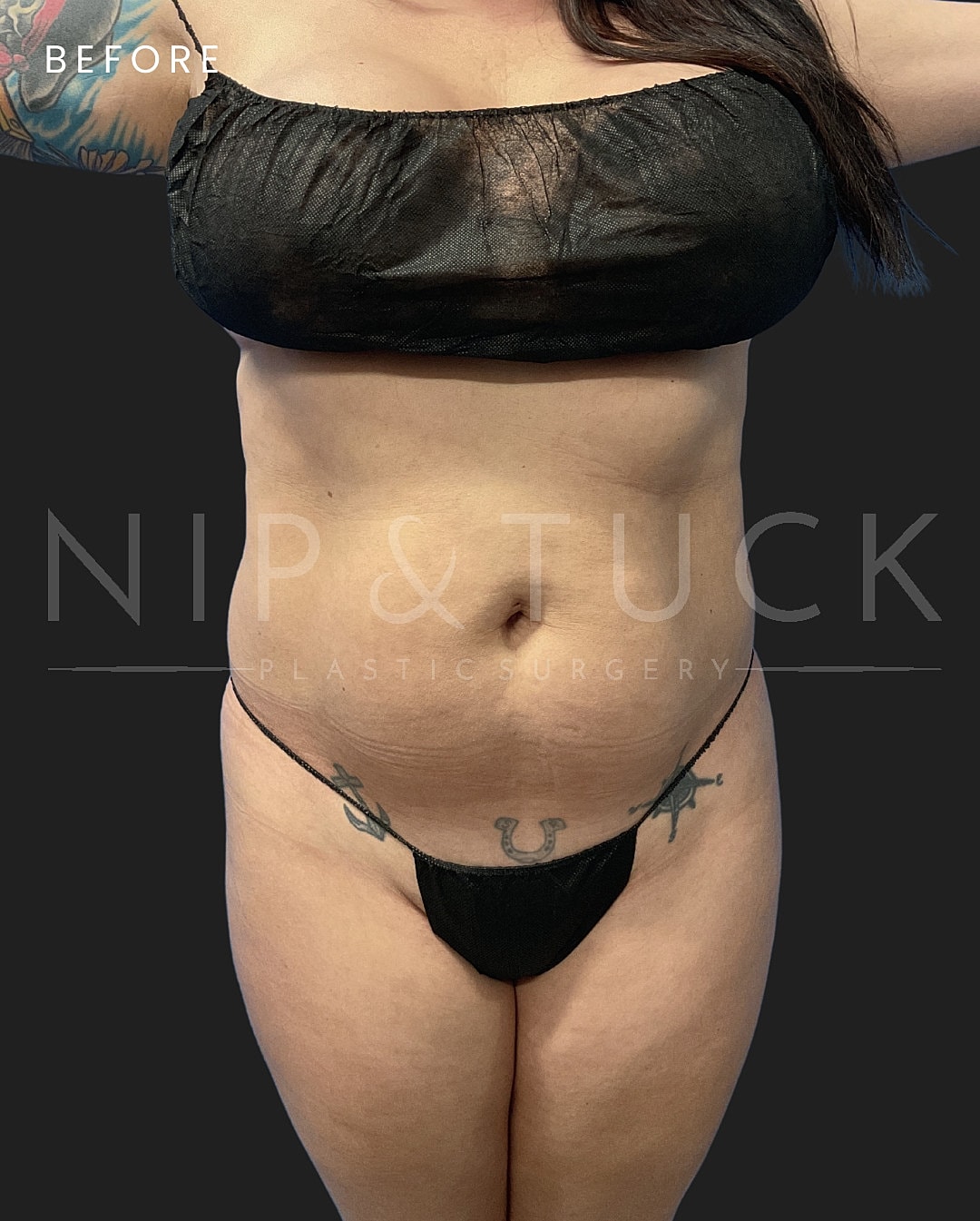 Lipo 360 Before & After