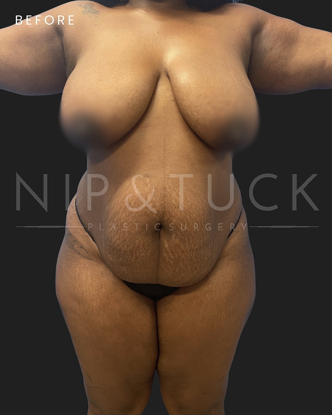Lipo 360 Before & After