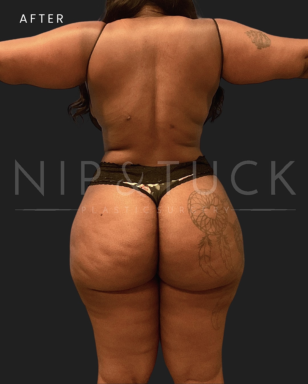 Lipo 360 Before & After