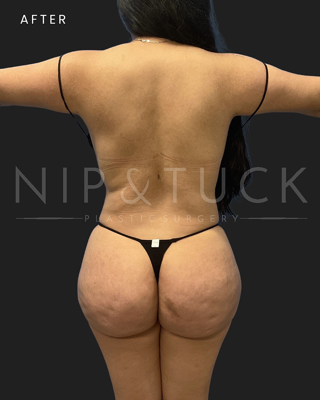 Lipo 360 Before & After
