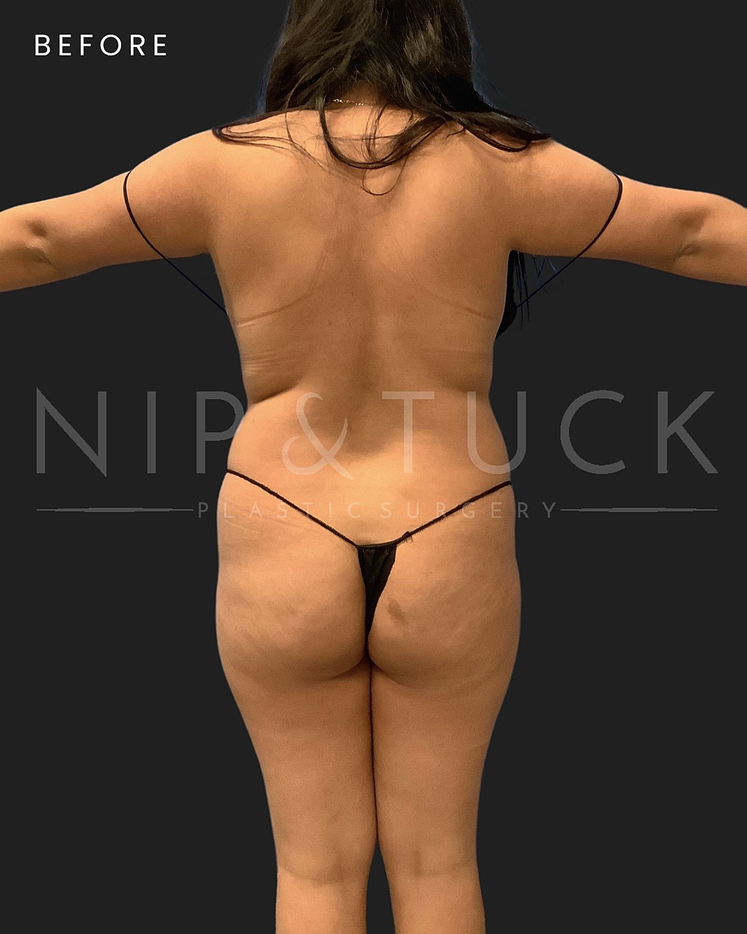 Lipo 360 Before & After