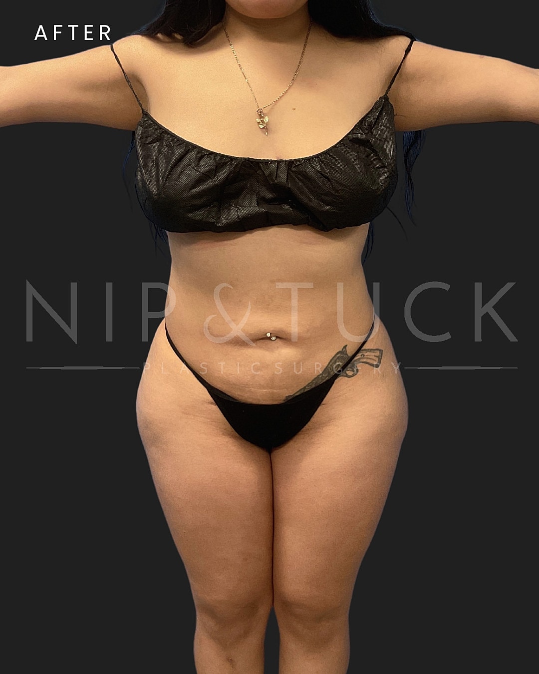 Lipo 360 Before & After