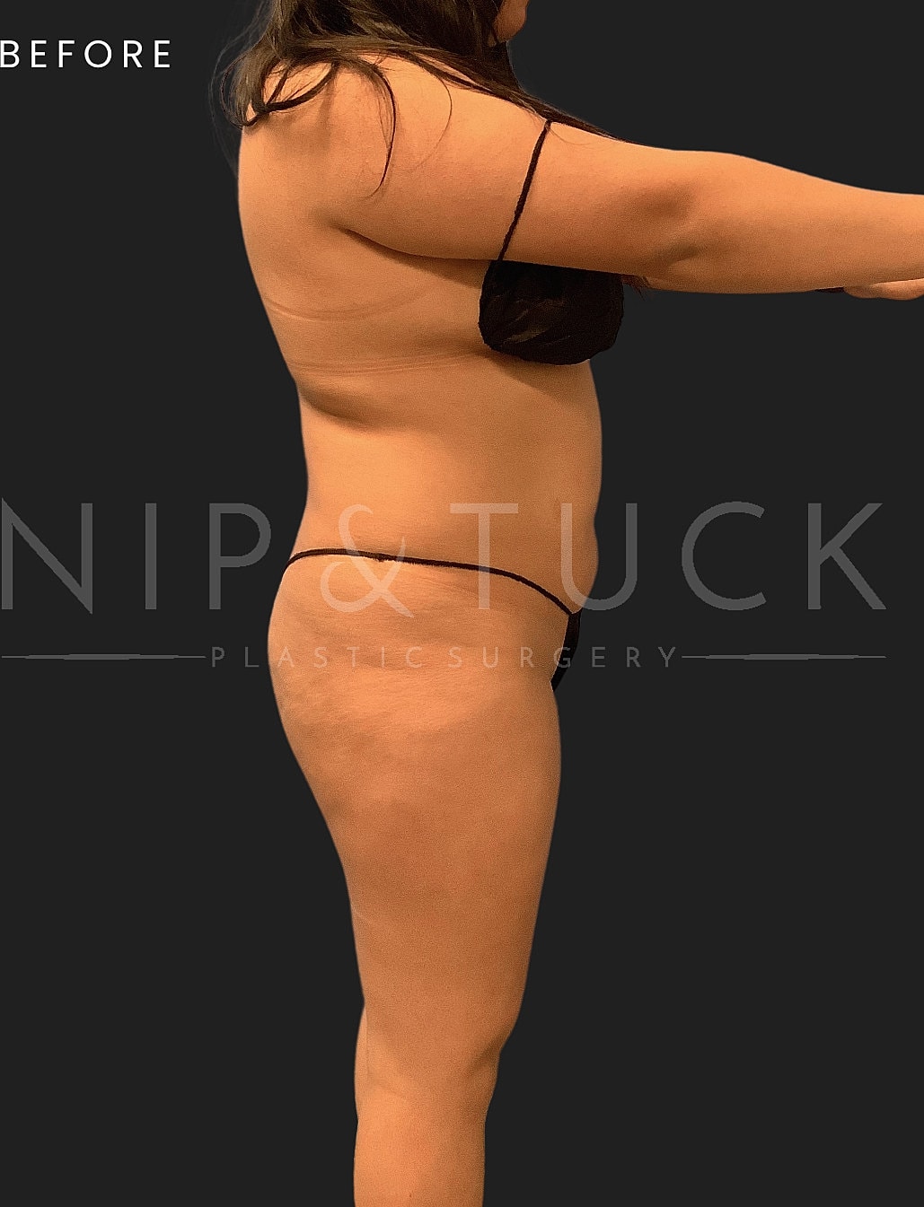 Lipo 360 Before & After