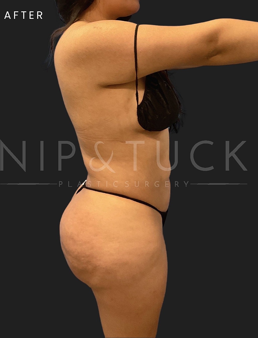 Lipo 360 Before & After