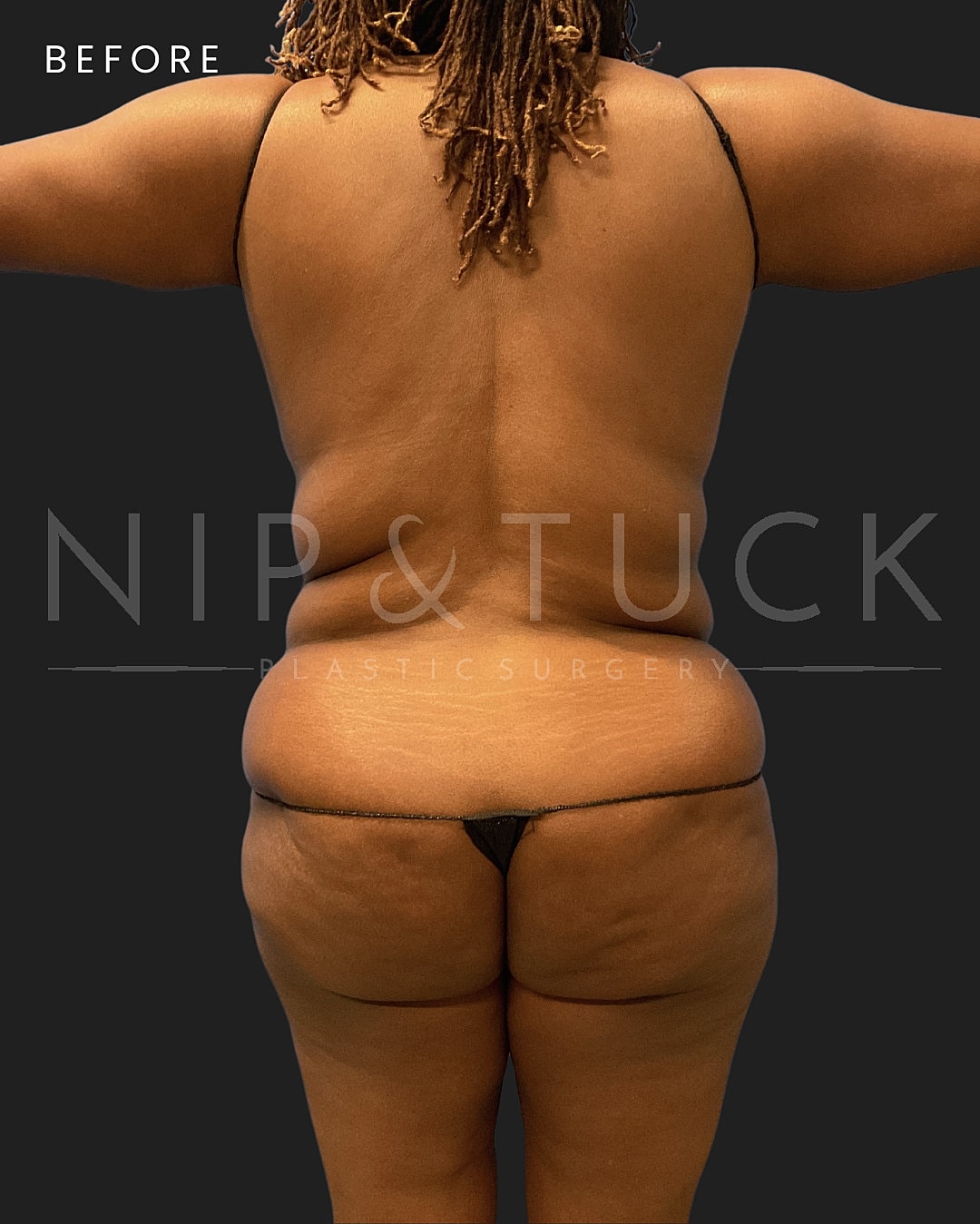 Lipo 360 Before & After