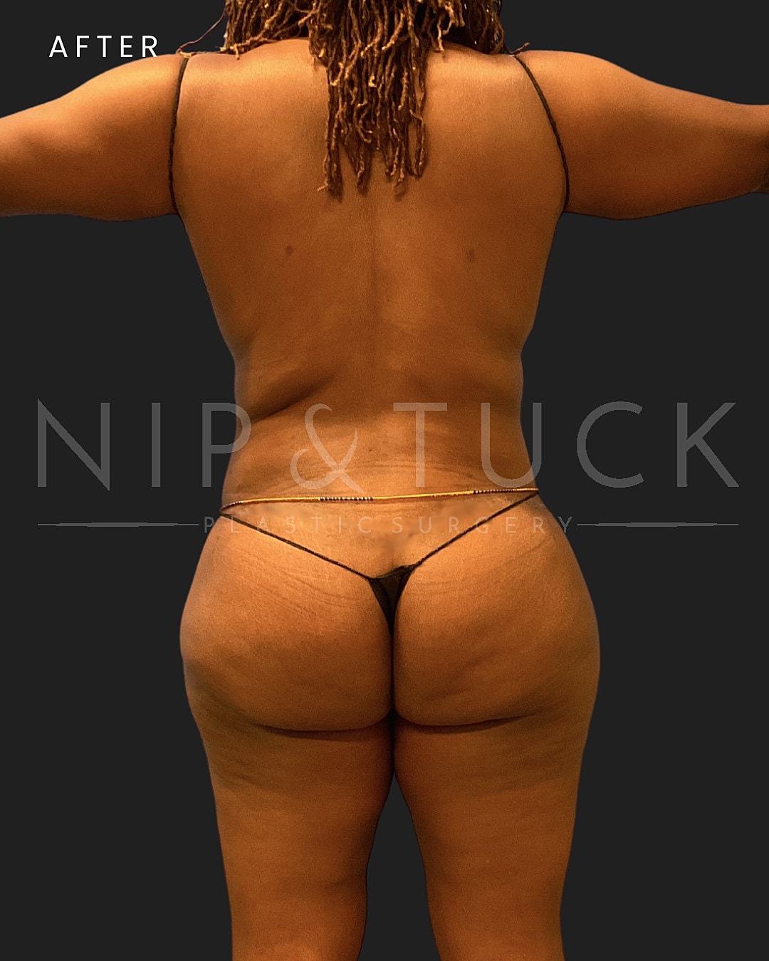 Lipo 360 Before & After