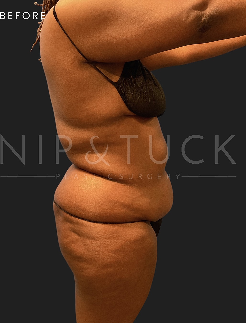 Lipo 360 Before & After