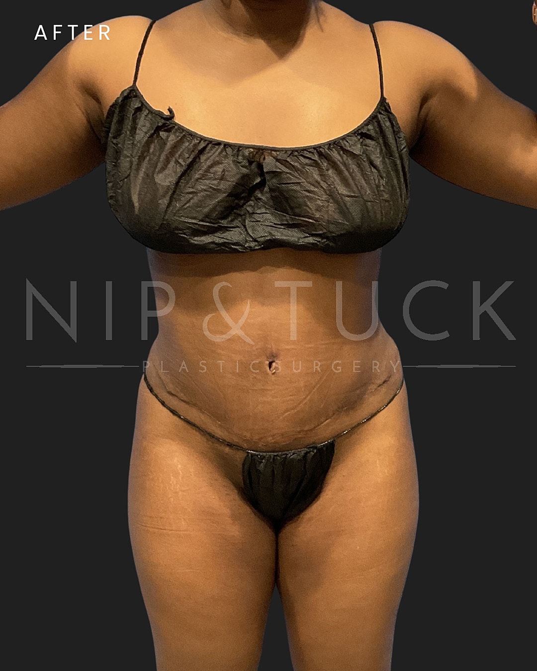 Lipo 360 Before & After