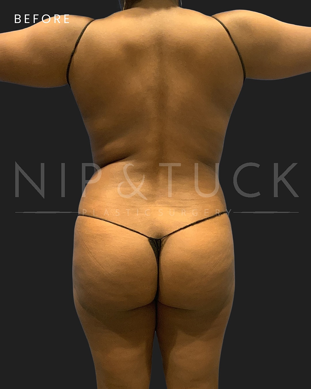 Lipo 360 Before & After