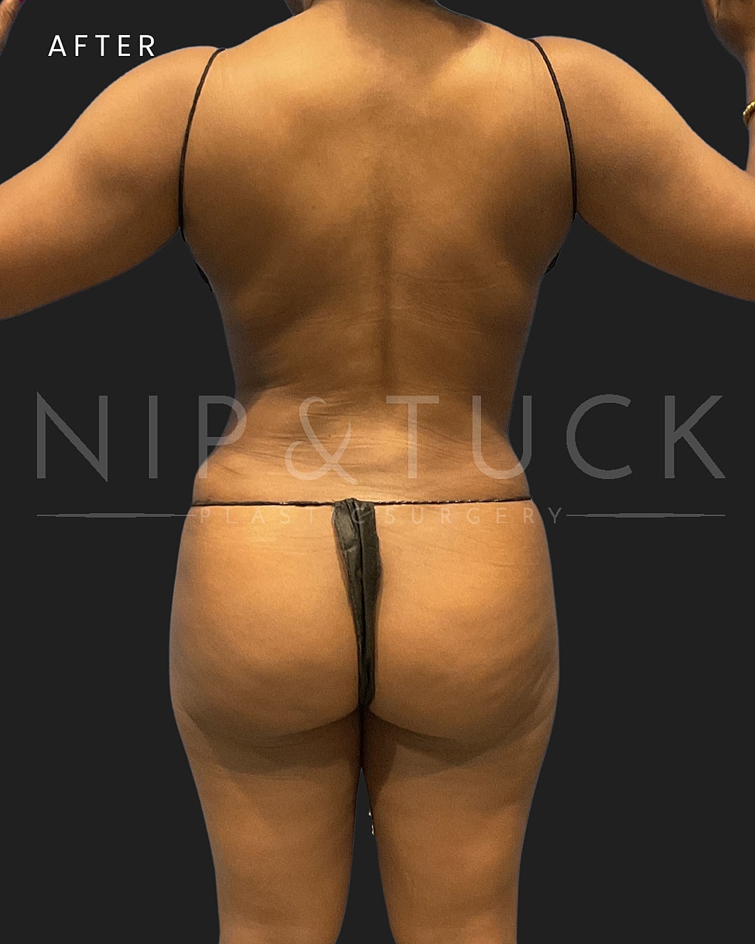 Lipo 360 Before & After