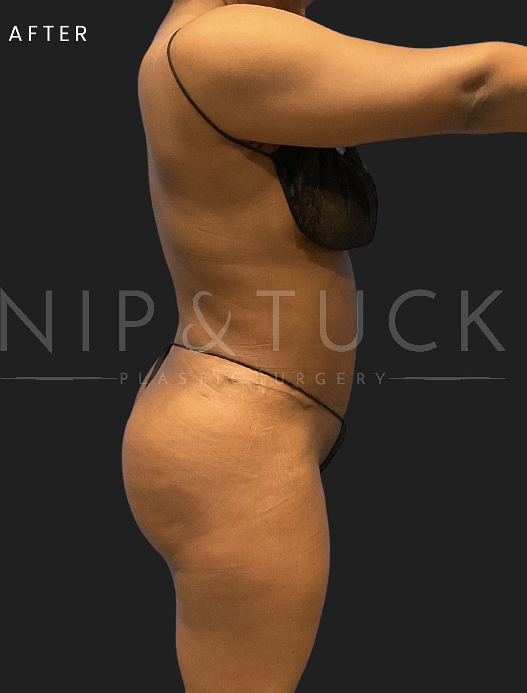 Lipo 360 Before & After