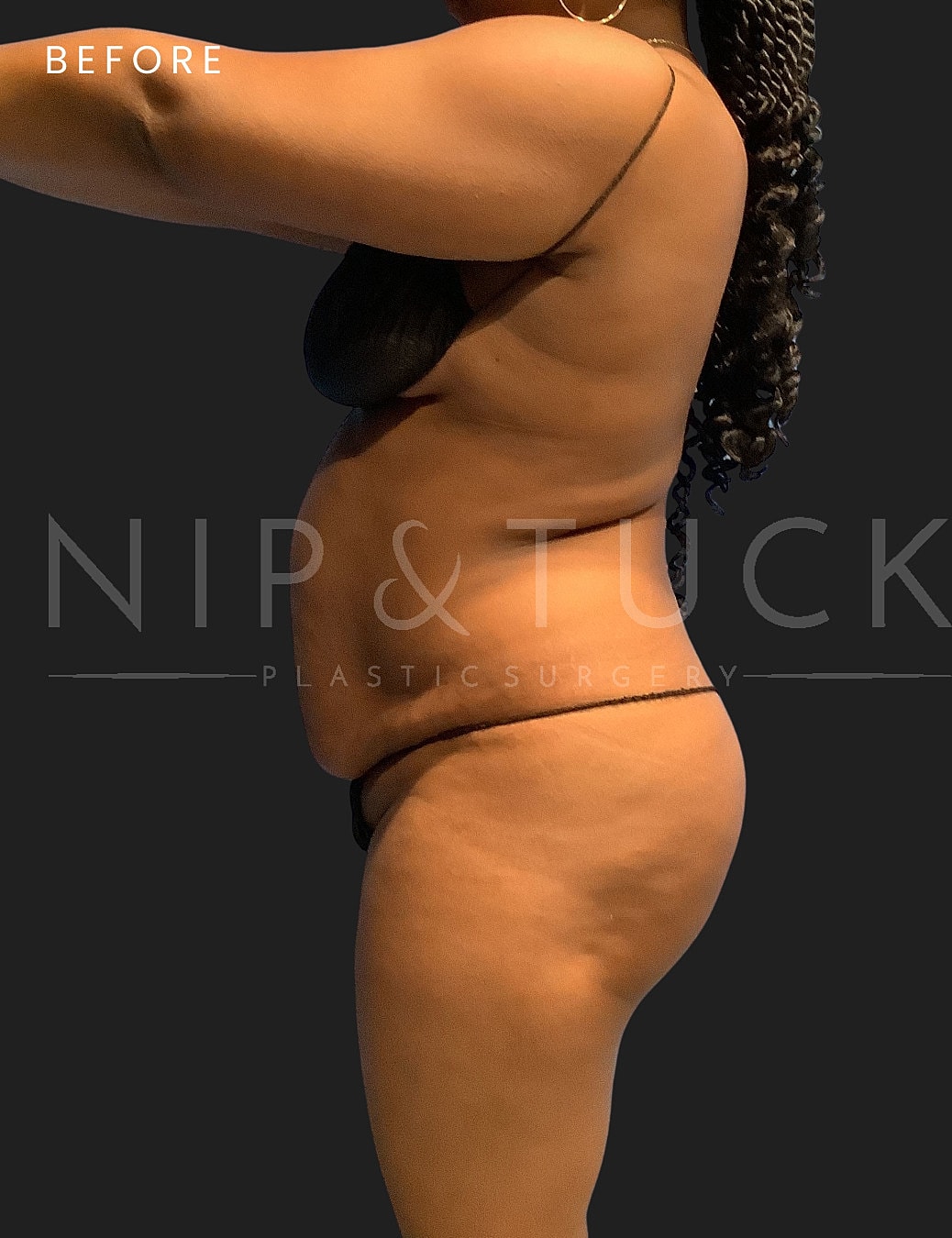 Lipo 360 Before & After