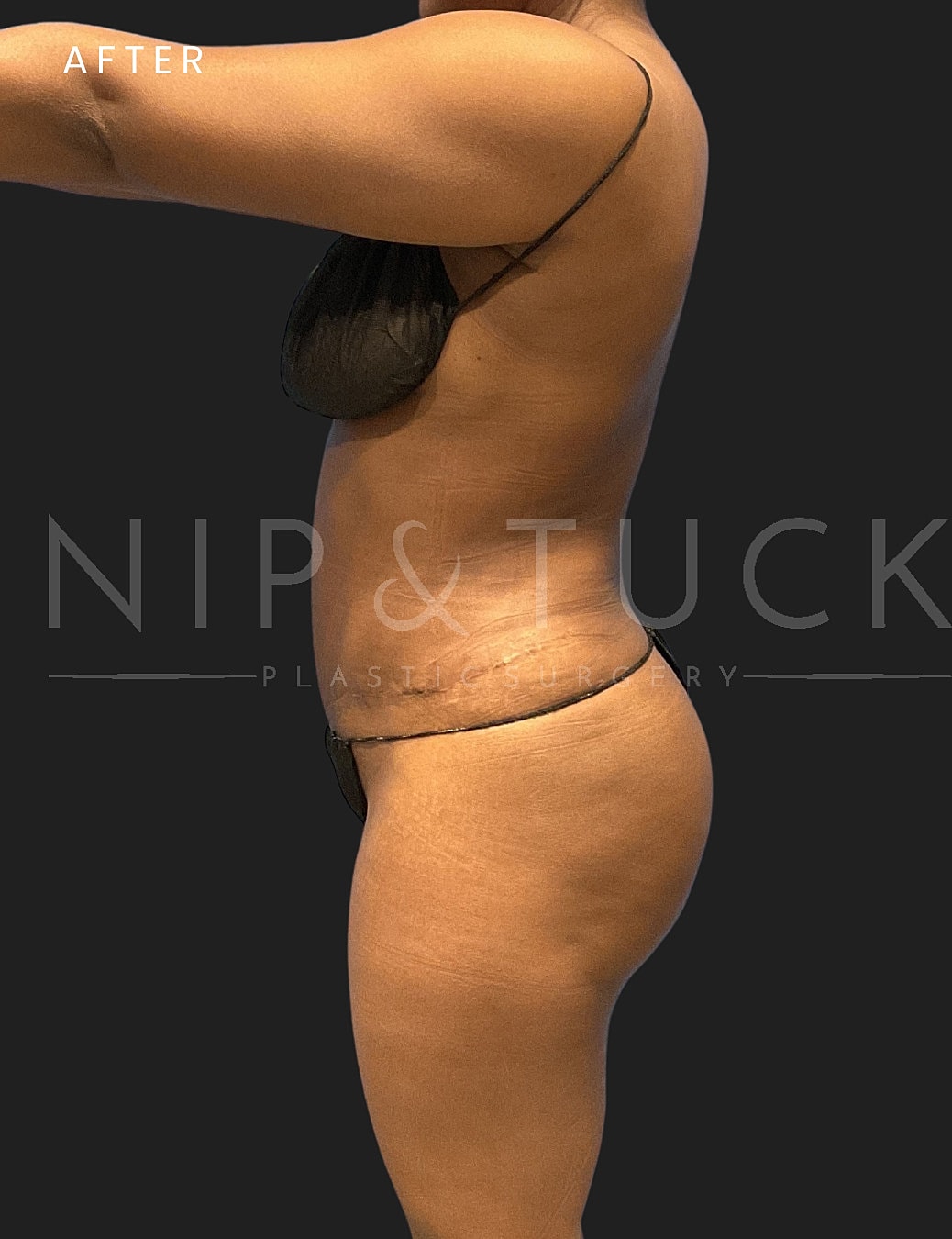 Lipo 360 Before & After