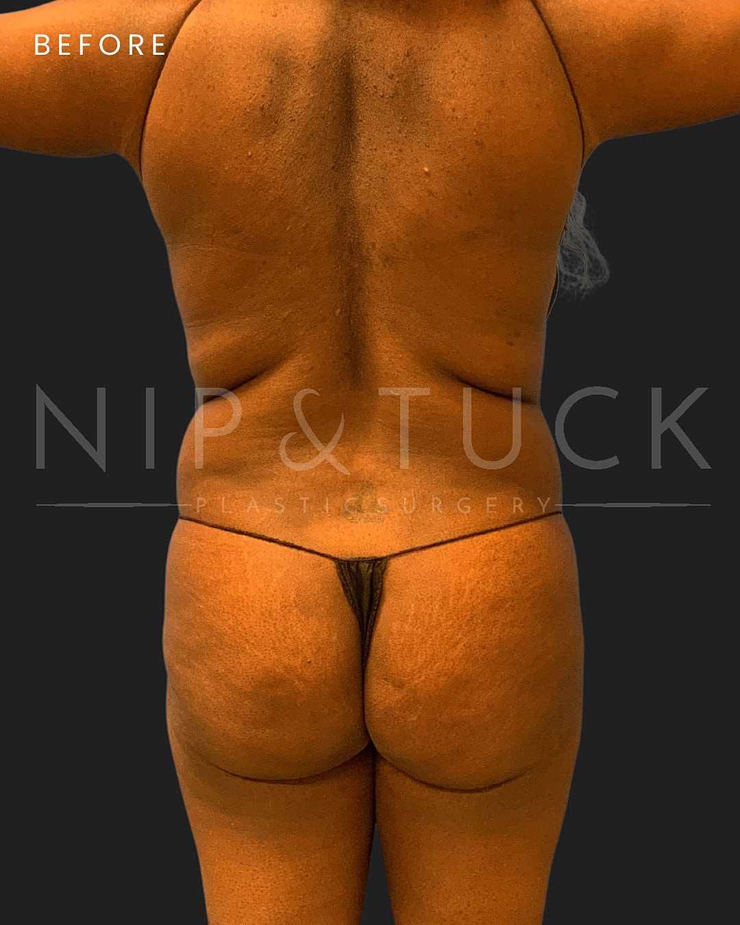 Lipo 360 Before & After