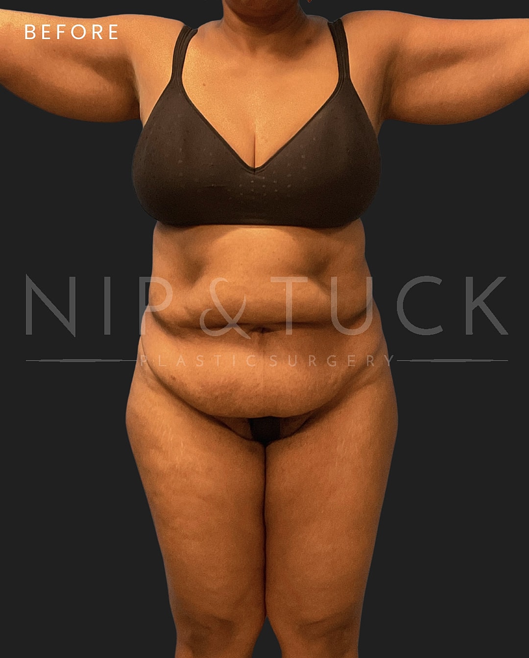 Lipo 360 Before & After