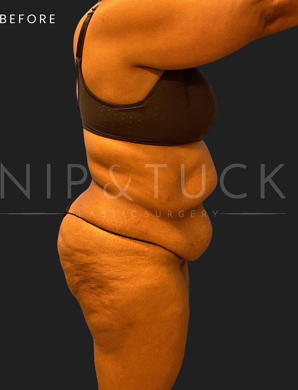 Lipo 360 Before & After