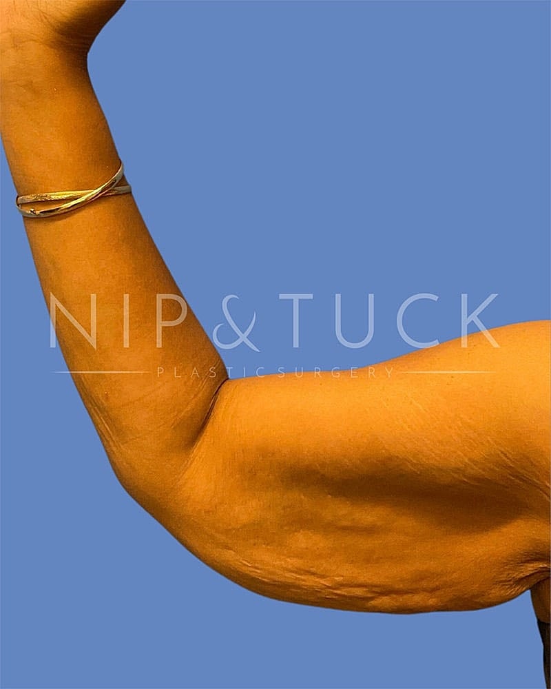 Arm Lift Before & After