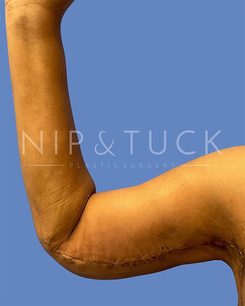 Arm Lift Before & After