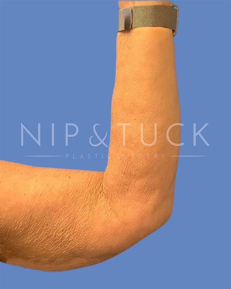 Arm Lift Before & After