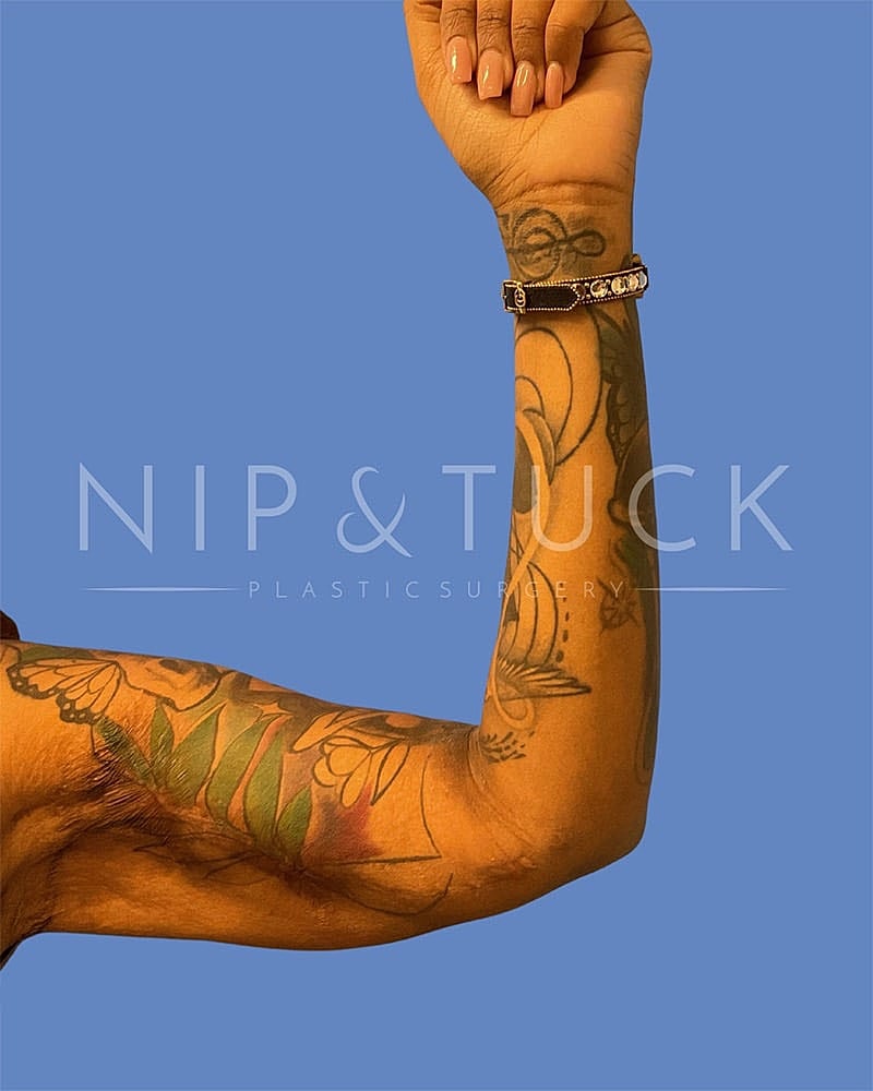 Arm Lift Before & After