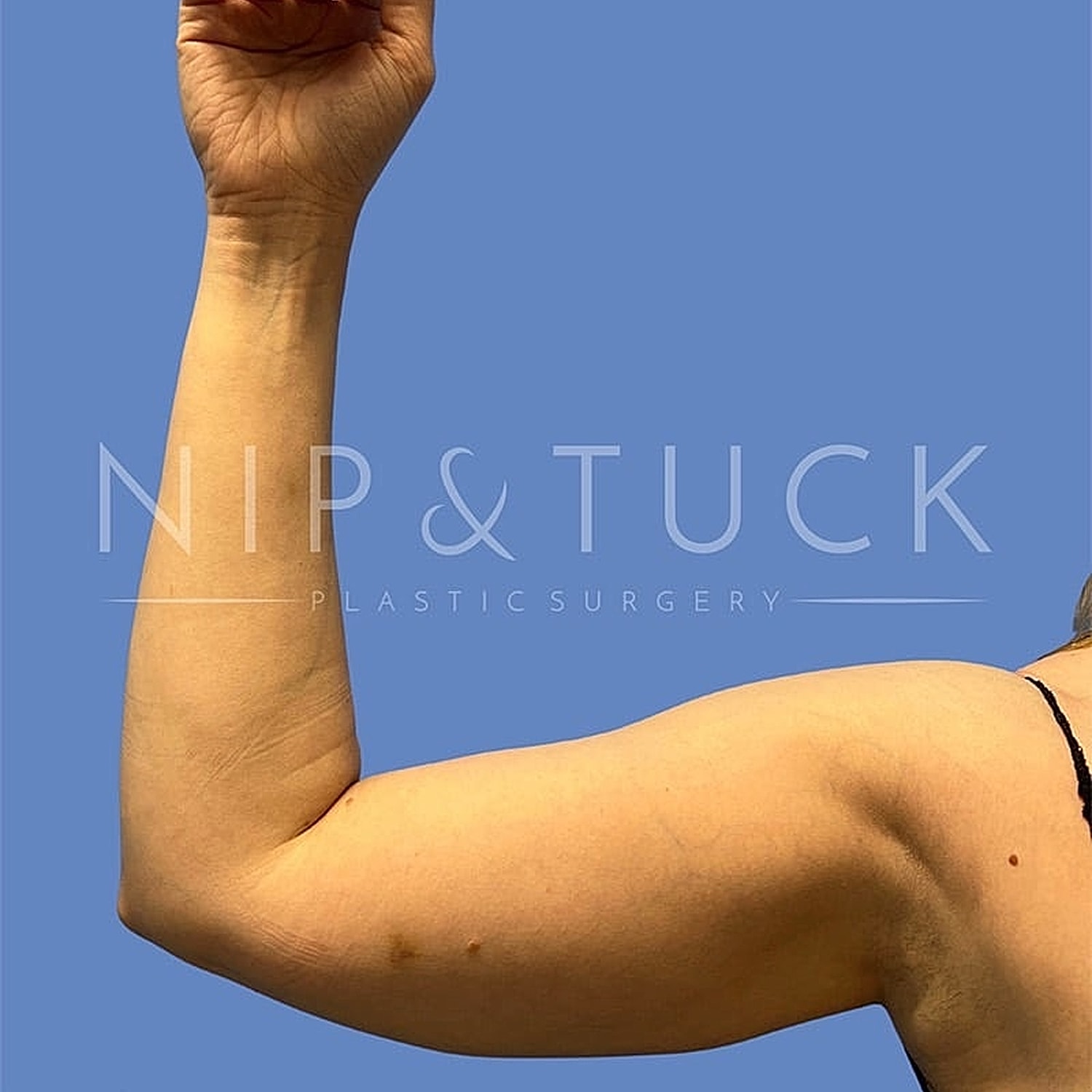 Demonstration of arm aesthetic from plastic surgery.