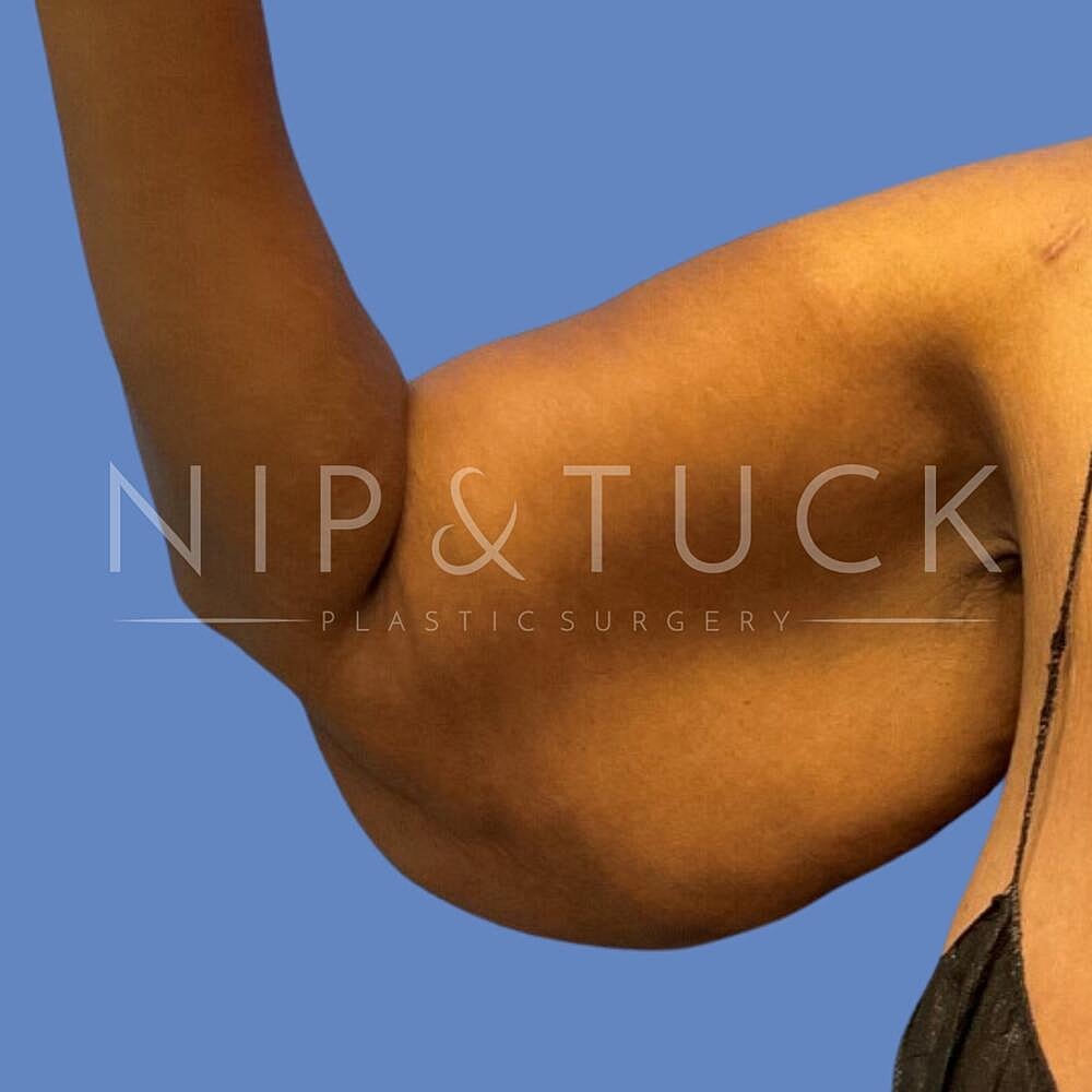 Arm Lift Before & After