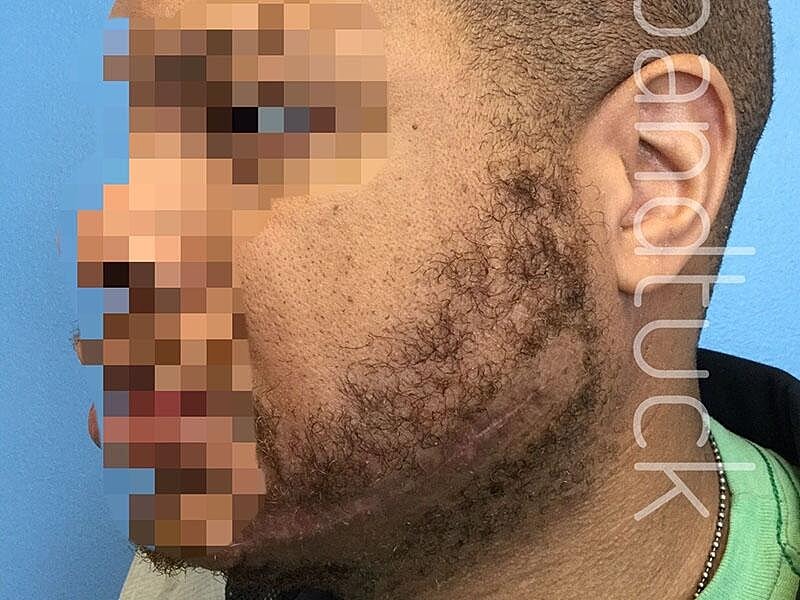 Scar Revision Before & After