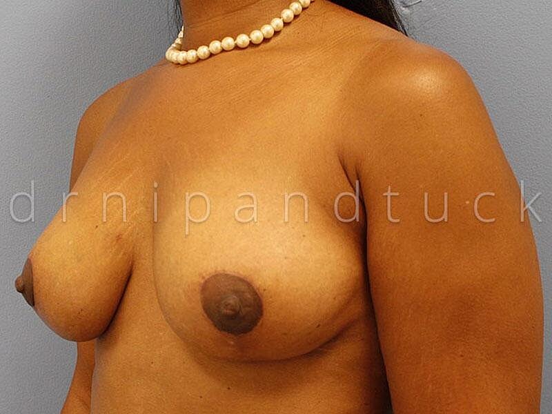 Mastopexy With Fat Grafting Before & After