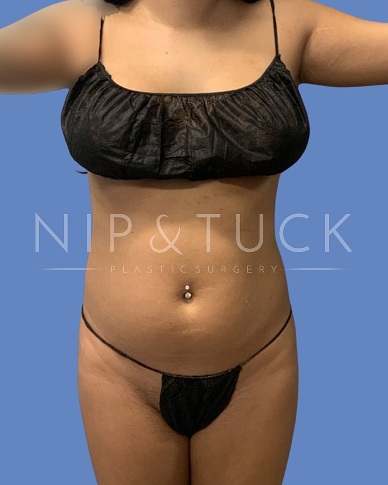 Liposuction Before & After