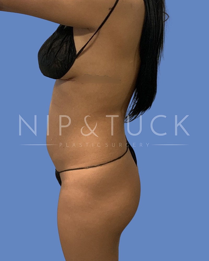 Liposuction Before & After