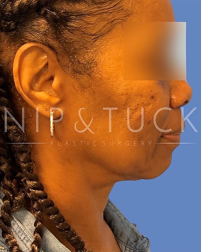 Liposuction Before & After