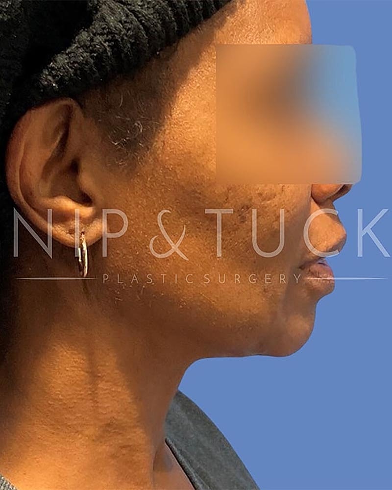 Liposuction Before & After