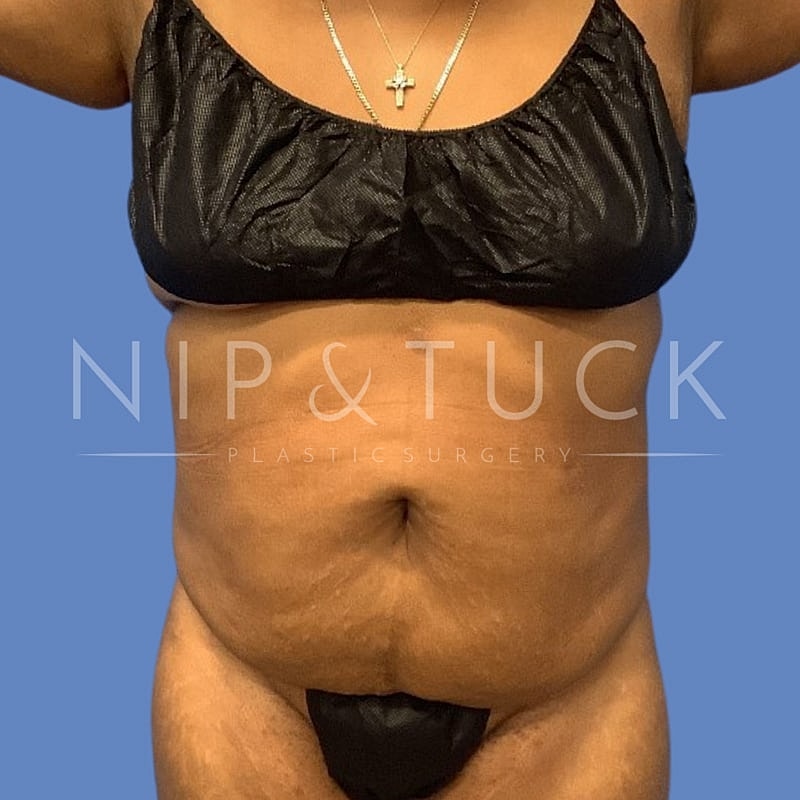 Liposuction Before & After