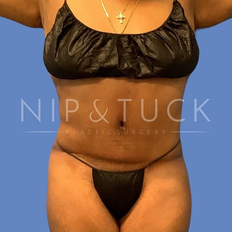 Liposuction Before & After