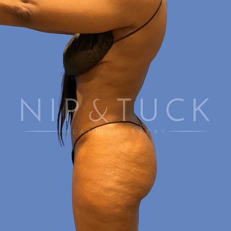 Liposuction Before & After