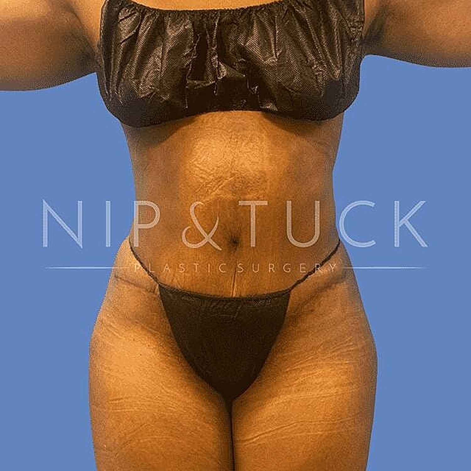 Liposuction Before & After