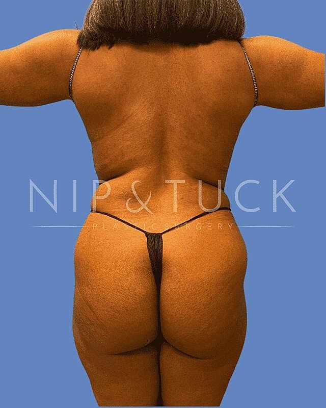 Liposuction Before & After